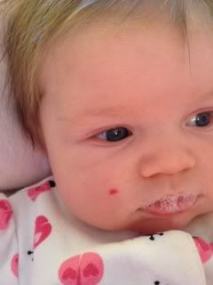 Strawberry Hemangioma (UPDATED 10/11/12) | BabyCenter