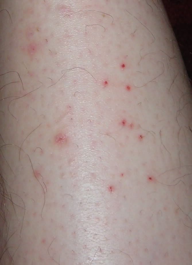 Possible herpes outbreak on shoulders and legs? | Go Ask ...